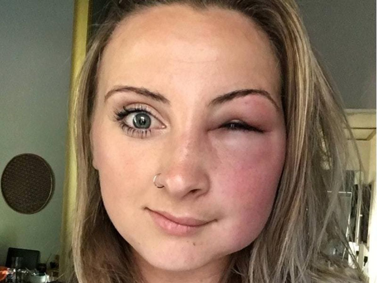 Heres What Happens If You Get Stung By A Bee Near Your Eye Shropshire Star 