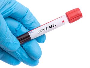 A vial labelled 'sickle cell'