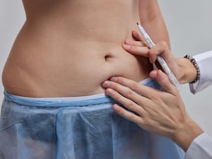 A doctor makes markings with a marker before a tummy tuck operation