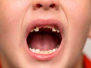 Child open mouth showing cavities teeth decay. Close up of unhealthy baby teeth. Dental medicine and healthcare.